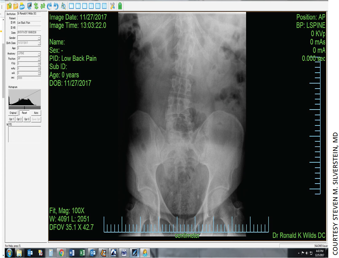 The X-ray that led to my diagnosis of repetitive motion syndrome. Note the curvature it has caused in my spine.