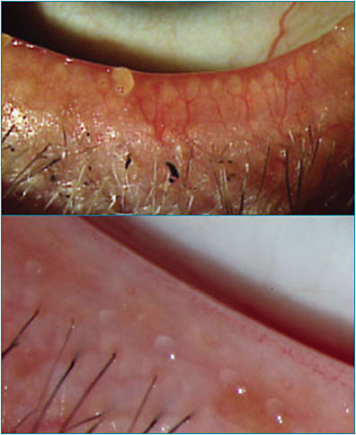 Figure 1. Intense pulsed light (IPL) therapy is one of many advanced therapies available for treating meibomian gland dysfunction/evaporative dry eye.