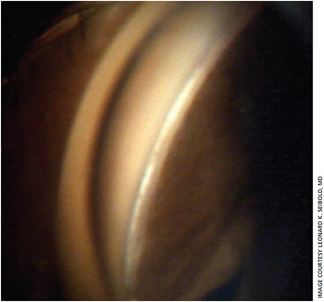 Figure 2. The anterior wall of the canal of Schlemm (white) can be observed post KDB treatment revealing minimal residual TM remaining.