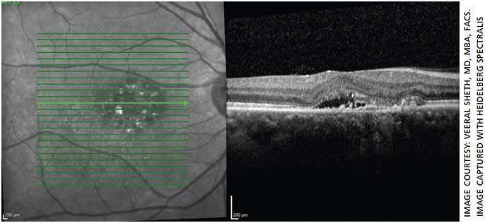 Figure 4. OCT of patient 2 weeks after micropulse laser treatment, showing improved fluid resolution.