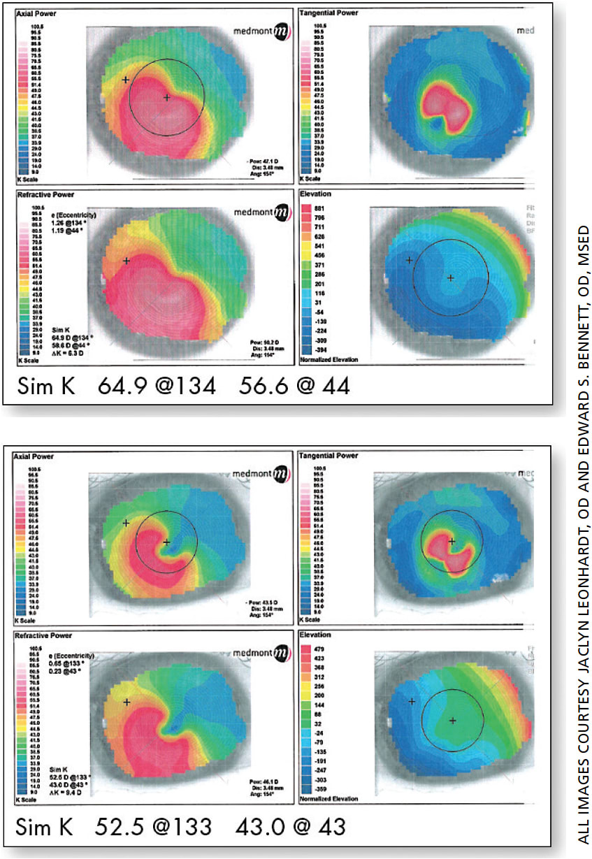 Four months after the procedure, the patient returned to the clinic in April 2016. The bottom figure shows his post-CXL corneal topography OD. He was fit with scleral lenses and his final visual acuities were 20/25 OD and 20/30+ OS.