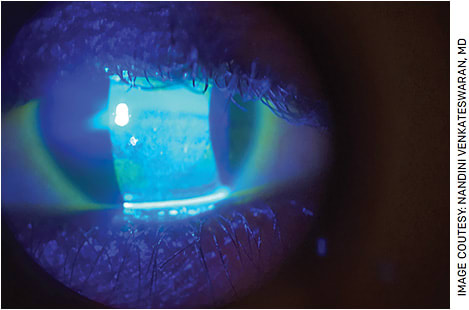 FIGURE 1. Fluorescein staining highlighting significant keratopathy in a patient with DED.