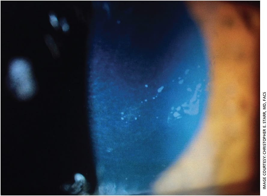 Figure 2. Slit lamp exam reveals anterior basement membrane dystrophy, which can present with patient complaints of dry eyes, grittiness and other similar symptoms.