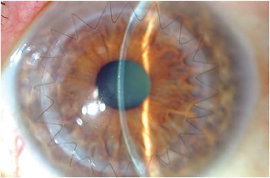 Zig-zag FLEK has emerged as a configuration for a keratoplasty incision.