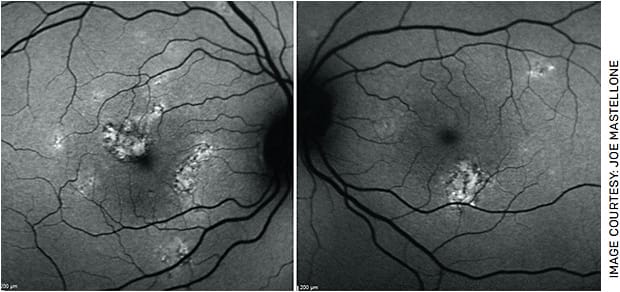 FIGURE 3. Fundus autofluorescence photos OU show patchy areas of hyper-autofluorescence in the fovea OD (left image) and inferior to the fovea OS (right image).