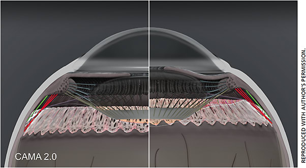 Figure 3. CAMA 2.0 demonstrating posterior zonules in accommodation (right half) and disaccommodation (left half).