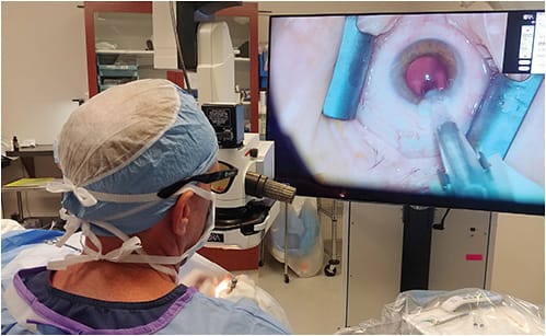 Figure 2. Dr. Weinstock operates heads-up with a 3D visualization system. &#x201C;The surgical microscope of today and the future is digitally enhanced,&#x201D; he says.