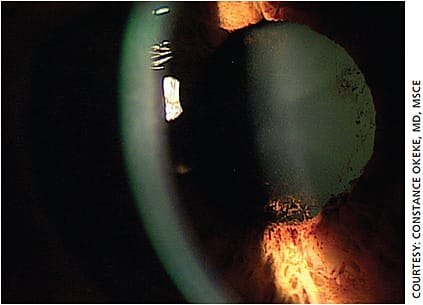 Figure 2. Posterior synechia and pigmentation on the anterior capsule indicate prior or active inflammation.