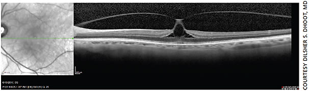 Spectral domain OCT showing vitreomacular traction with associated distortion of foveal anatomy.