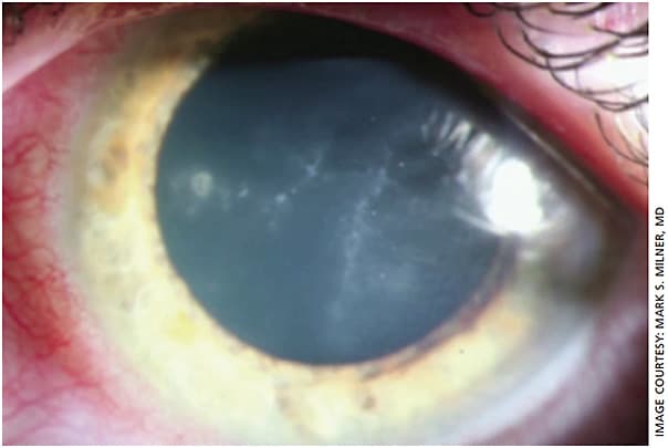 Figure 2. Radial perineuritis in Acanthamoeba