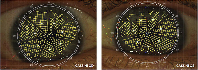 Cassini surface qualifier demonstrating an unstable tear film with missing and bowed lines.