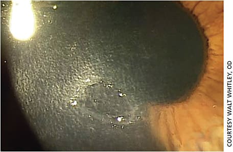 Figure 3. Stage 2 NK from prior HSV keratitis. The breakdown of the epithelium is within the prior HSV site and the scar from the HSV is faint but present.