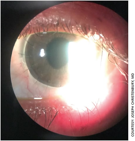 Figure 2. Slit lamp photo of Acanthamoeba ulcer after therapeutic PKP showing clear graft.