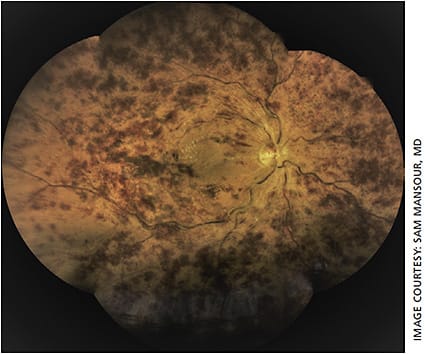 Figure 1. Central retinal vein occlusion. Right eye fundus color image obtained from the Icare USA Eidon TrueColor Confocal Scanner.