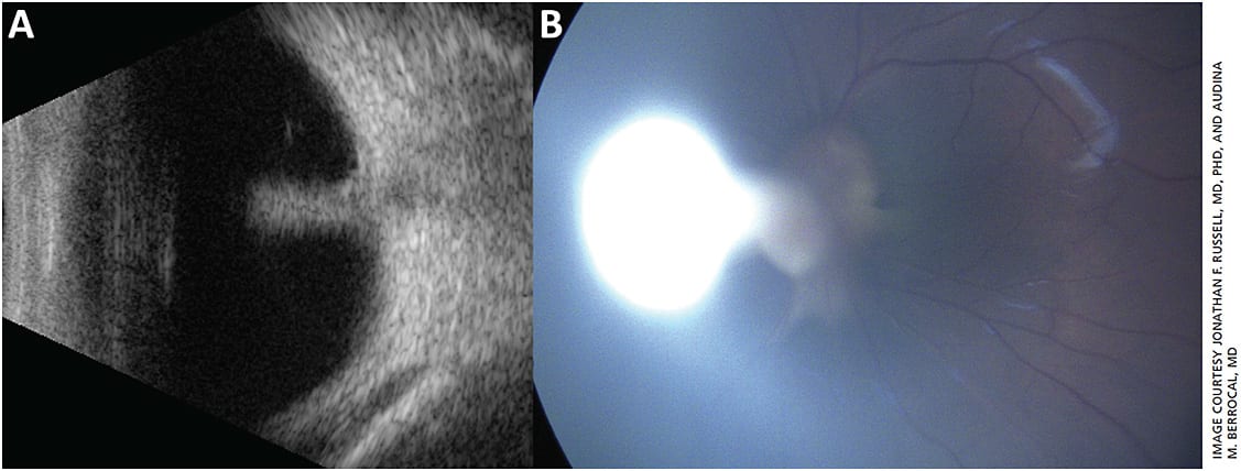 Figure 4. Ultrasound (A) and fundus photograph (B) of persistent fetal vasculature with cataract in a child. Images obtained via Quantel and Retcam devices.