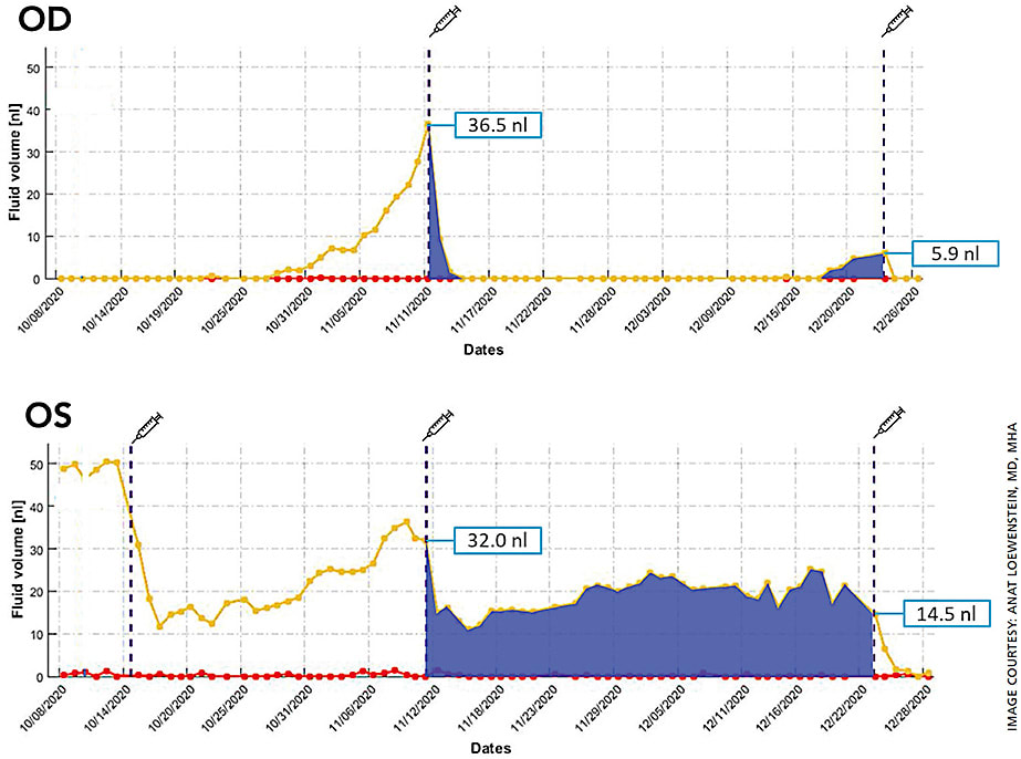 Figure 2. Intraretinal fluid (IRF) and subretinal fluid (SRF) volume trajectories from Notal OCT Analyzer (NOA) segmentation of daily home OCT self-images of a patient’s right and left eyes. Retinal fluid exposure described by the area under the curve between treatments differs significantly between eyes despite similar fluid volumes measured on the day of office treatment visits, illustrating the medical insights gained from daily OCT imaging at home.