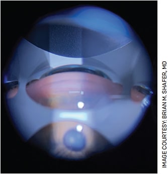 Gonioscopic view of Durysta (Allergan) in the inferior iridocorneal angle