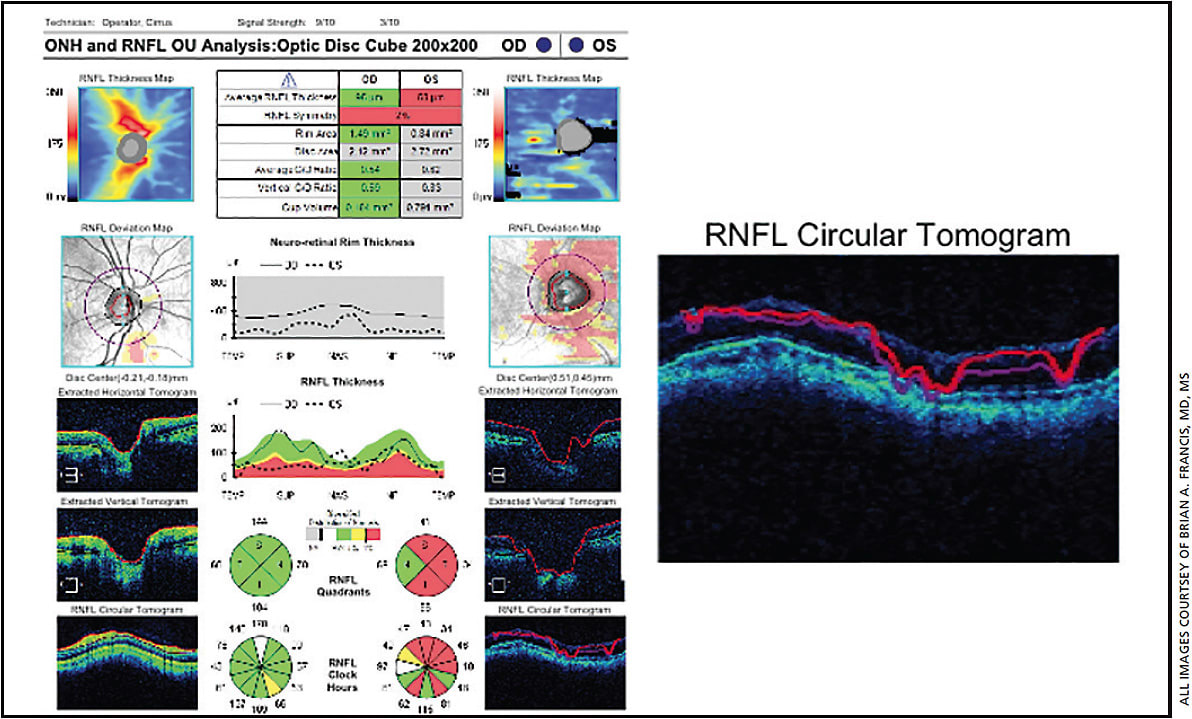 Figure 2. Segmentation error on OCT: This peripapillary RNFL scan shows a normal scan in the right eye with good quality and a poor quality scan in the left eye with abnormal RNFL measurement. Note the poor scan signal (3/10) and error in segmentation in the RNFL circular tomogram (Zeiss Cirrus OCT).