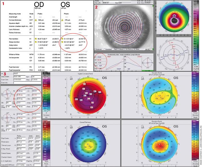 FIGURES 1-3. Measurements from a 72-year-old female candidate for cataract surgery in her left eye who also had moderate keratoconus. They underline the differences measured in keratometry by the Lenstar (Haag-Streit) (Figure 1), within the red oval highlighted area: 51.12 D and 55.16 D at 95°.