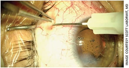 Figure 2. Injection of the 0.1 cc of STK in the superior nasal sub-Tenon’s space 7 mm from the limbus.