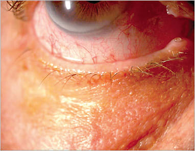 Figure 1. Meibomian glad dysfunction is a prevalent cause of OSD. A careful look at the eyelid margin can help to identify gland plugging or scarring.