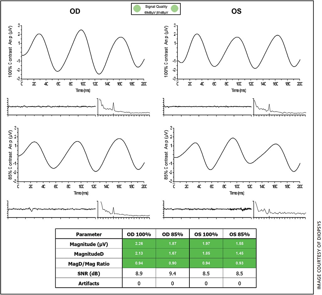 Figure 2. An example of a “normal” Diopsys PERG test result. Healthy results typically include three equally spaced sinusoidal waveforms on the graphs and parameters at both contrast levels within normal ranges (green) in the data table.