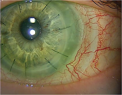 Scleral lenses can promote rapid healing in NK patients.