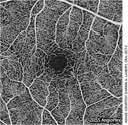 Figure 1. 3 mm x 3 mm superficial vasculature.