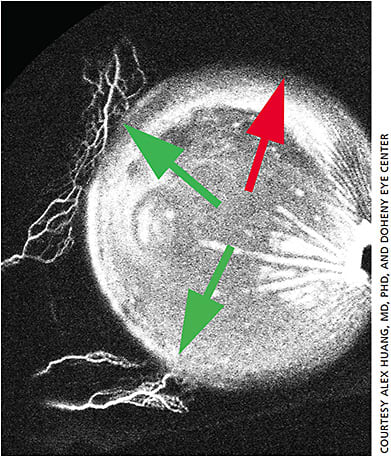 Aqueous angiography performed in the left eye of a 60-year-old Asian female during cataract surgery. 0.4% indocyanine green (ICG) was introduced into the anterior chamber. Angiographic images were taken using a Spectralis OCT+HRA (Heidelberg Engineering). Centrally, the anterior chamber was filled with ICG. Posterior to the limbus, green arrows show areas of distal angiographic outflow; the red shows a region without.