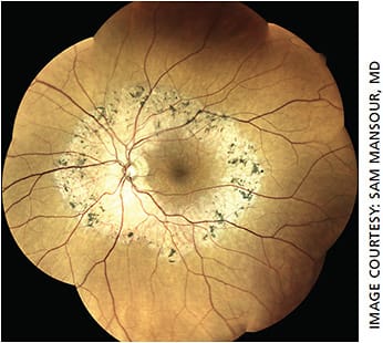 Figure 2. Pericentral retinitis pigmentosa. Left eye fundus color obtained with the Icare USA Eidon TrueColor Confocal Scanner.