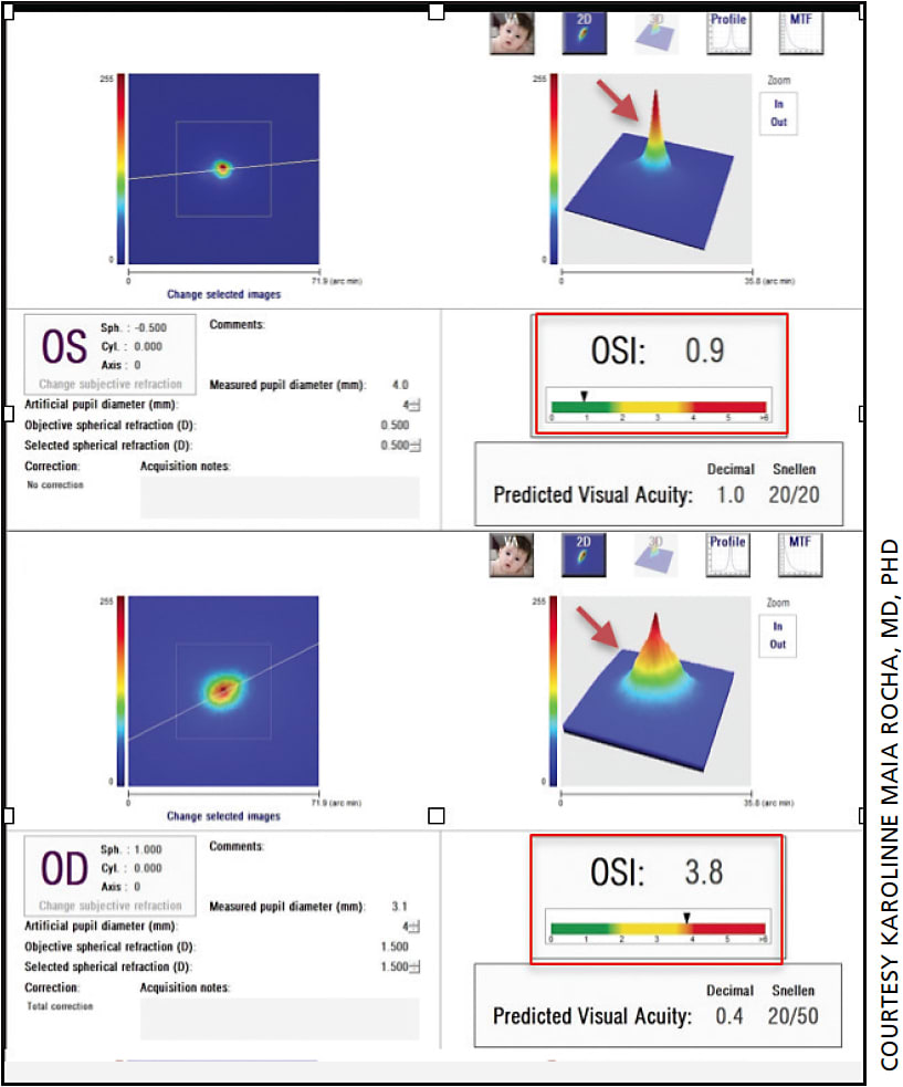 Figure 1. A normal (top) vs. high (bottom) Ocular Scatter Index (OSI) result. The normal one could be a good candidate for laser vision correction or corneal inlay, while the eye in the bottom image would not.