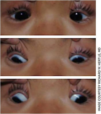 Figure 7. Congenital fibrosis of the extraocular muscles.