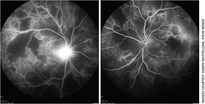 Figures 2a and 2b. Fluorescein angiogram OU demonstrating widespread ischemic regions OU (dark) with scattered vascular leakage and neovascularization of the disc OD, seen as leakage of the fluorescein dye, indicative of progression to proliferative diabetic retinopathy OD.