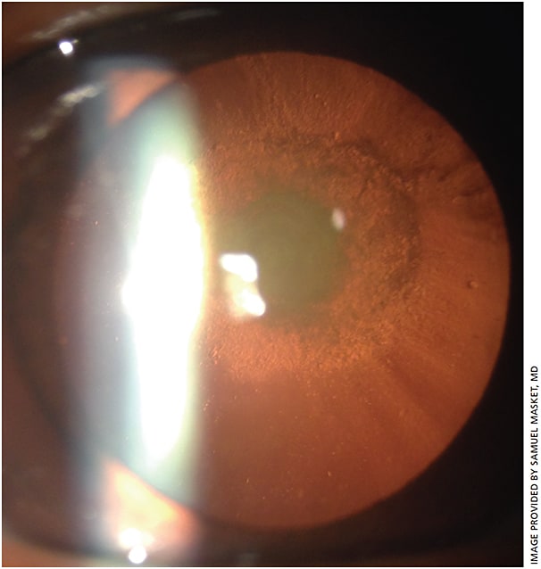 Figure 2.  Posterior polar cataract.