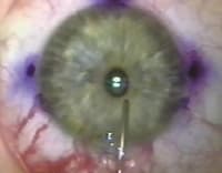 A cohesive viscoelastic is placed in the eye during phakic IOL implantation. (Image courtesy of Kerry Assil, M.D.)