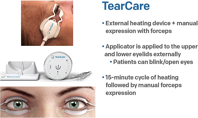 Figure 2. TearCare is a customizable system for the treatment of MGD.