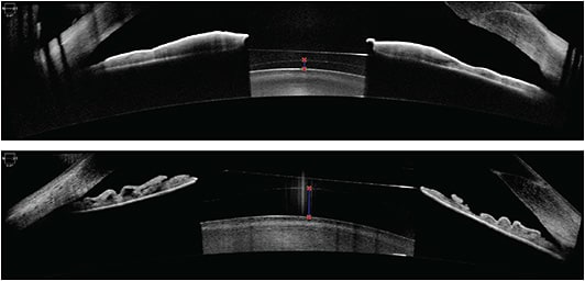 AS-OCT images depicting adequate vaults (250 μm and 740 μm, respectively) of an ICL over the natural crystalline lens. IMAGE COURTESY KATHRYN HATCH, MD