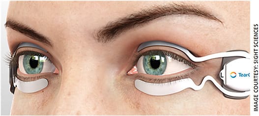 Figure 2. Sight Sciences’ TearCare system