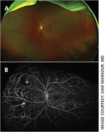 Figure 5. Proliferative diabetic retinopathy demonstrating neovascularization and extensive capillary dropout in the nasal periphery. Left eye fundus color image (A) and fluorescein angiogram (B) obtained using the Optos California UWFI SLO camera.