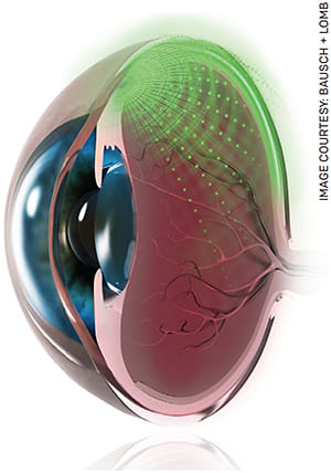 Xipere uses the suprachoroidal space for drug delivery.