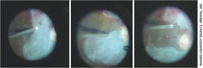 Figure 5. Intraoperative photographs of 23-27 mixed gauge microincision vitrectomy using the beveled cutter probe which illustrates the versatility of the vitreous cutter in removal of the fibrovascular proliferation (FVP). Sequential intraoperative photographs show segmentation and removal of FVP using the cutter both simultaneously for cutting as a scissor and aspiration.