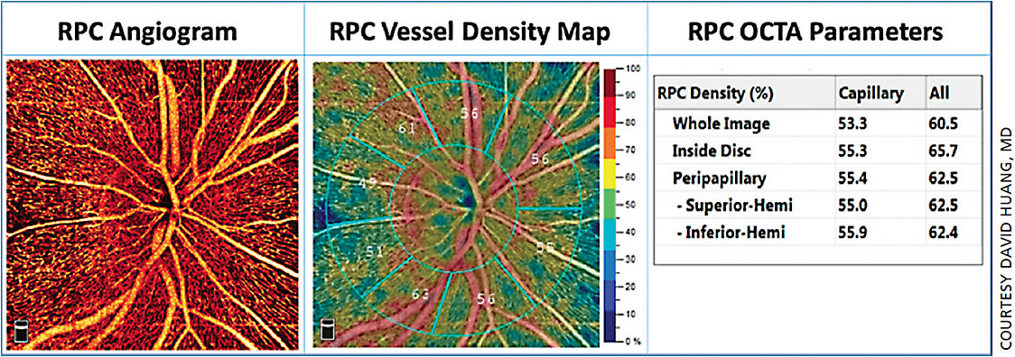 Figure 1. The 4.5 mm x 4.5 mm high-definition (400x400 scans) angiogram of a normal eye was quantified by AngioAnalytics, the commercially available software on the AngioVue OCTA system. The most superficial vascular plexus, the radial peripapillary capillaries (RPC), was analyzed. The sectoral vessel densities were showed in the RPC vessel density map. The RPC parameters provide capillary density (vessel density measured after excluding larger vessels from analysis) in the first column and vessel density in the second column.