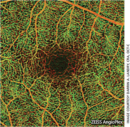 Figure 2. Color depth-enhanced image illustrating superficial vasculature (orange) and deep retinal plexus vessels (green).