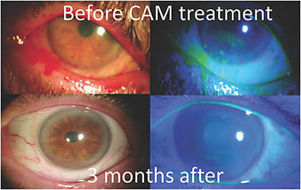 Figure 1. Ocular surface health and dry eye symptoms and severity improved in 88% of patients.