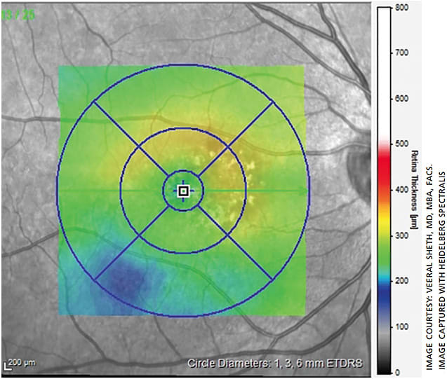 Figure 5. OCT of patient 4 weeks after treatment showing continued improvement.