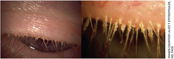 FIGURE. Left: Demodex blepharitis patient looking down during slit lamp exam with collarettes visible. Right: A close up view of collarettes on the same patient.