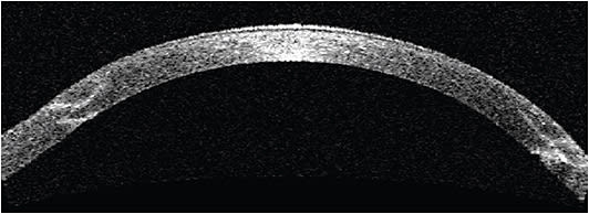 FIGURE 3: Note the AS-OCT showing adequate wound integrity, allowing for initiation of suture removal in femtosecond laser-assisted PK with “zig-zag” cut. IMAGE COURTESY SOROOSH BEHSHAD, MD, MPH