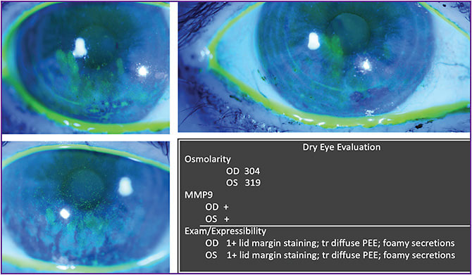Figure 3. Despite the presence of diffuse punctate epitheliopathy, the patient reported no pain or burning, only fluctuating vision.