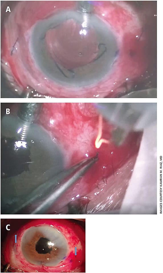 Figure 2. The Yamane technique for scleral fixation of a posterior chamber intraocular lens (IOL), part 2. The trailing haptic is subsequently externalized through a scleral tunnel located 180 degrees away from the first tunnel (A). Disposable cautery is used to gently melt the haptic tips until a mushroom shape is achieved (B). Both haptics are then tucked into the sclera, with fine adjustments made until there is good centration and stability of the IOL (C).