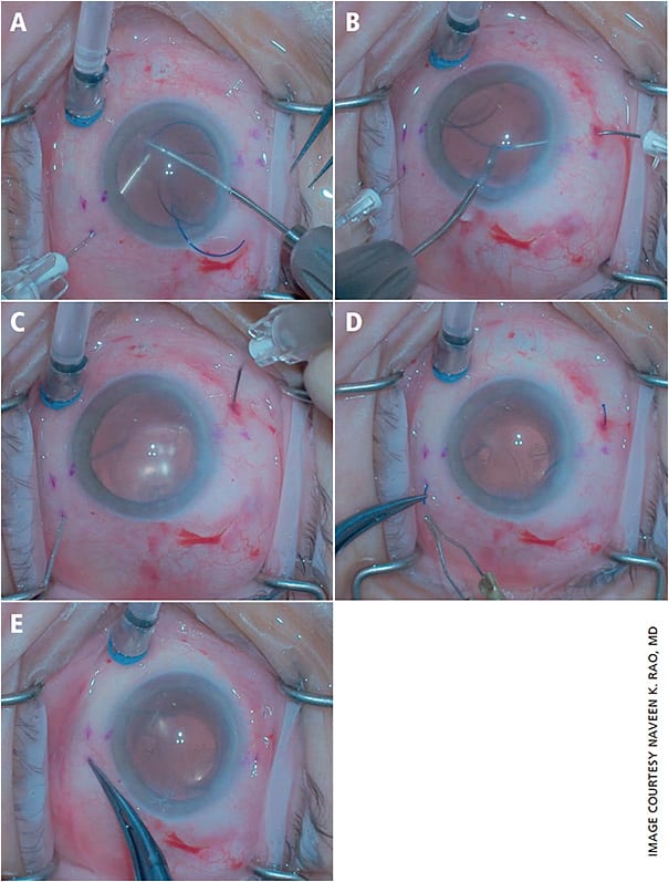 Figure 2. Flanged haptic ISHF (Yamane technique). A. The leading haptic is docked into the lumen of the first needle. B. The trailing haptic is docked in a similar manner. C. Needles are simultaneously withdrawn. D. The haptic ends are melted with low-temperature cautery. E. The IOL centered well upon the conclusion of surgery.